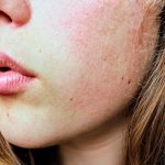 Skin pigmentation natural remedies