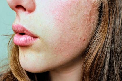 Skin pigmentation natural remedies