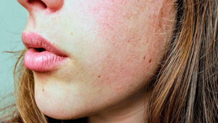 Skin pigmentation natural remedies