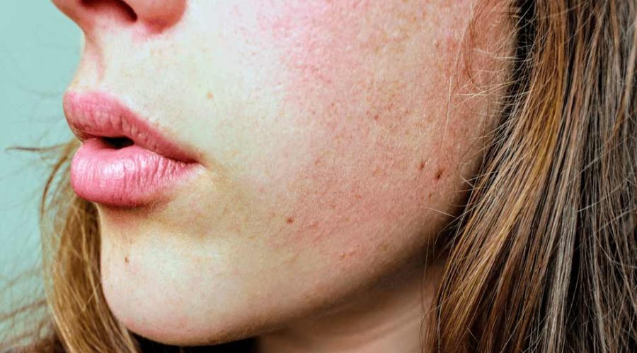 Skin pigmentation natural remedies