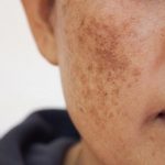 Get rid of dark spots on the skin naturally