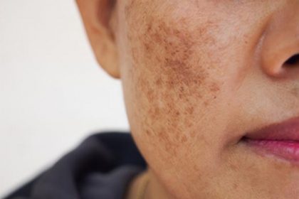 Get rid of dark spots on the skin naturally