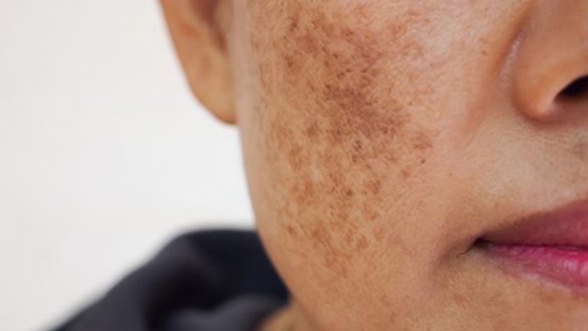 Get rid of dark spots on the skin naturally